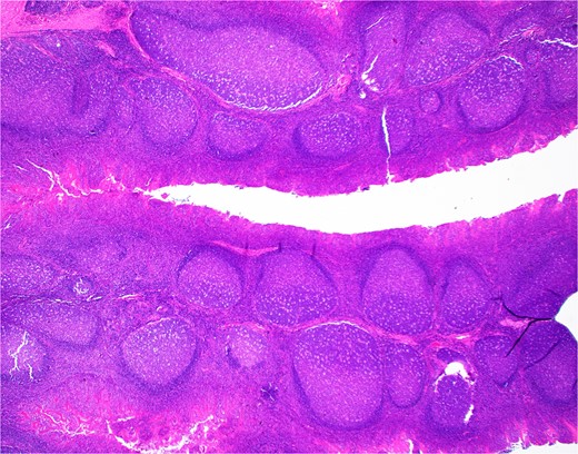 H&E section from Case 1 tonsillectomy. Representative H&E section (20×) of Case 1 tonsillectomy showing intact architecture, follicular and MZH with follicles having definitive polarity and abundant tingible body macrophages.