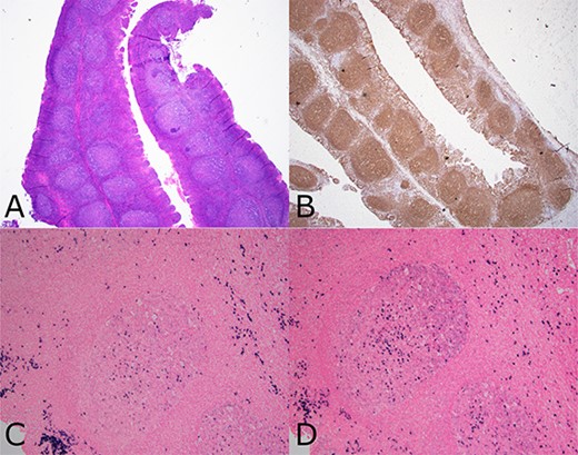 Composite photomicrograph from case 2 tonsillectomy. Composite photomicrograph from case 2 tonsillectomy showing (a) tonsil (H&E 20×) with follicular and MZH showing intact architecture and well polarized follicles. (b) CD20 immunohistochemistry (20×) showing B cell enrichment of follicles. (c and d) show the same follicle (100×) having lambda light chain predominance (d), including many dark zone B cells having diffuse lambda reactivity without as much kappa (c).
