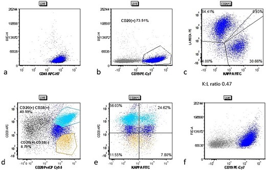 Cytometric analysis scatter plots from case 2 tonsillectomy. Case 2 flow cytometric analysis scatter plots showing (a) live gate with mostly CD45(+) lymphocytes, (b) CD20(+) B cells (dark blue), (c) B cells showing a decreased Kappa:Lambda ratio of 0.47, (d) gating for CD38(−) (orange) and CD38(+) (cyan) B cells, and (e) the CD38(−) and CD38(+) populations show more pronounced lack of kappa surface light chain.