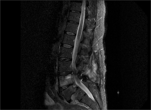 Sagittal view of MRI of lumbar spine demonstrating diffuse soft tissue pathological sign, with signs of osteomyelitis at the level of L4 and L5.