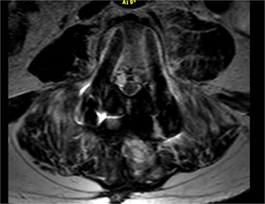 Axial view of the MRI scan demonstrating pathological fluid collection around the pedicle screws.