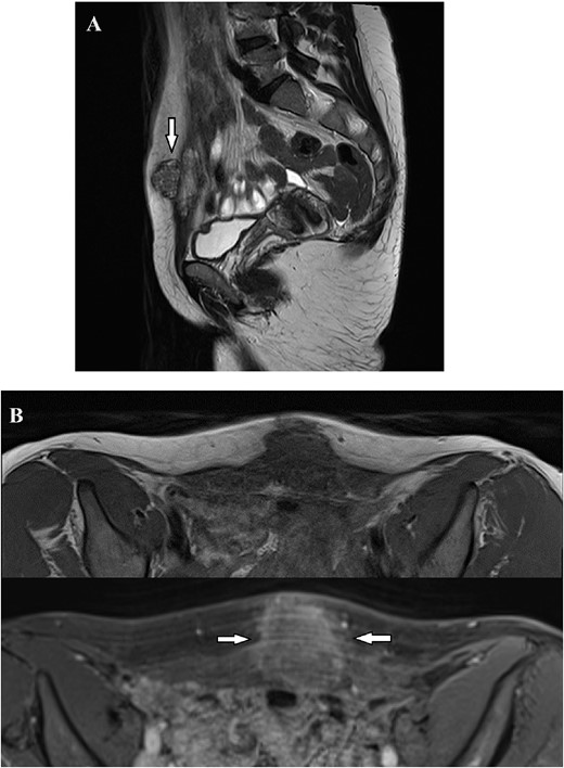 Magnetic Resonance Imaging showed a solid irregularly shaped mass with high contrast enhancement signal, measuring 36×32×26 mm infiltrating the abdominal wall. (A) Nodular formation (arrow) infiltrating the suprapubic area, exhibiting heterogeneous signal in T2-weighted images, extending from the subcutaneous tissue to the transversalis fascia. (B) T1 Weighted images before and after intravenous contrast of Dotarem. Following the contrast infusion, heterogeneous post-contrast enhancement was observed (arrows).