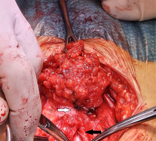 A laparotomy was conducted according to Kustner technique, cutting away from mass boundaries as they were defined through subcutaneous, fascial and rectus muscle dissection. The subcutaneous extension of the mass has been dissected dorsally to the infiltrated fascial layer (upper arrow). In order to safely define the limit of the mass, the median fascial incision and celiotomy conducted above its cranial extension are in progress (lower arrow).