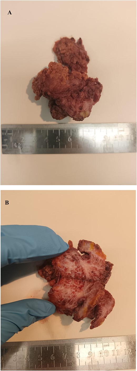 Macroscopic features of the resected abdominal wall adenomyoma. The removed specimen measured ~6 cm and it is shown before (A) and after its equatorial section (B). It appears as a whitish fibrotic mass with irregular boundaries infiltrating adjacent soft tissues.