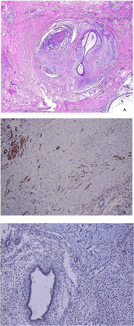 (A) Non atypical endometrial glands and stroma, surrounded by smooth muscle tissue, representing the mainstay features of adenomyoma, are shown after hematoxylin–eosin stain (4× magnification). (B) The immunohistochemical staining to desmin indicates the muscle cells counterpart of the mass (10× magnification). (C) The negative immunohistochemical staining to myogenin indicates a non-skeletal origin of muscle cells (10× magnification).