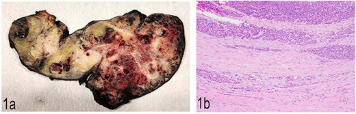 (a) Gross anatomy of the distal pancreas and spleen involved by the mass. (b) Well-differentiated acinar cells, well-differentiated neuroendocrine tumor and LCNEC, H & E, 2×.