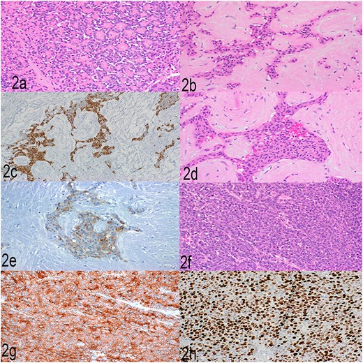 (a) Well-differentiated acinar cells, H&E, 2×. (b) Well-differentiated neuroendocrine tumor, H&E 20×. (c) Well-differentiated neuroendocrine tumor, synaptophysin, 20×. (d) Squamoid nests, H&E, 20×. (e) Squamoid nests, EMA, 20×. (f) LCNEC, H&E, 20×. (g) LCNEC, synaptophysin, 20×. (h) LCNEC, Ki67, 20×.