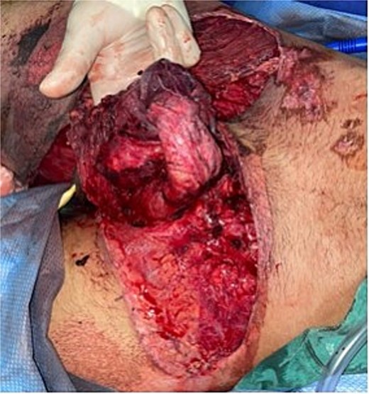 Complete scrotal exposure, denuded penis without exposure of the vascular pedicle at the frenulum, complete exposure of the base of the corpora cavernosa without involvement of the albuginea.