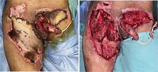 Necrosis and escharectomy of fasciocutaneous flaps on the right thigh, left inguinal region, and suprapubic area.