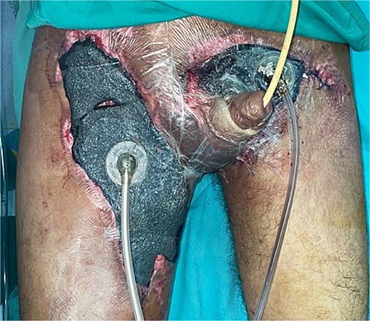 Application of circumferential negative pressure therapy with WhiteFoam to the circular defect at the penile body and granufoam to the right thigh, left inguinal region, and suprapubic area.