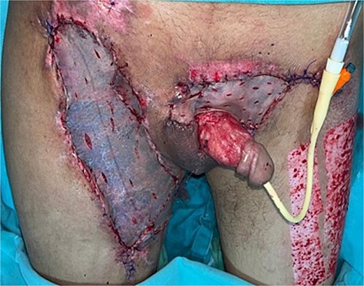 Removal of negative pressure therapy and placement of partial-thickness grafts in the raw areas of the right thigh, left inguinal region, and suprapubic area.