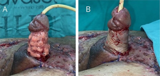 (A) Application of nanofat grafts circumferentially around the penile body. (B) Placement of spiral full-thickness grafts to cover the circumferential defect of the penile body.