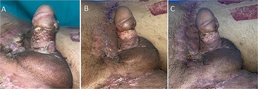 Postoperative images on days 7 (A), 14 (B), and 21 (C) following reconstruction.