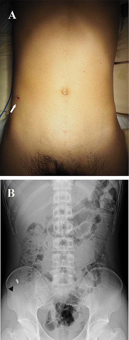 (A) Photograph showing a 1 cm entrance wound, similar in appearance to a stab wound above the right iliac crest (arrow). (B) Spinal abdominal radiograph showing a 1 cm-sized radiopaque object in the lower right abdomen (arrow head).