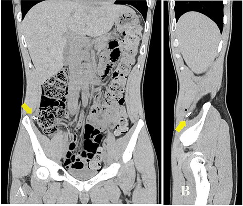 Abdominal CT showing a radiopaque object near the peritoneum. (A) coronal view; (B) sagittal view (arrows).
