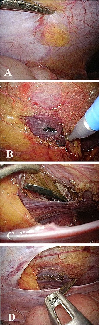 Intraoperative laparoscopic view. (A) No peritoneal damage was confirmed, and the foreign body could not be seen through the peritoneum. (B) Peritoneal incision and muscle dissection made in the area nearest to the foreign body. (C) Foreign body found in the transversus muscle. (D) Foreign body grabbed and removed using forceps.