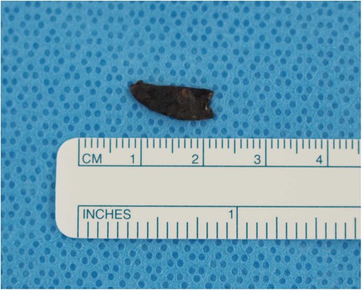 Photograph showing a foreign body 1.5 cm long and sharp at both ends.