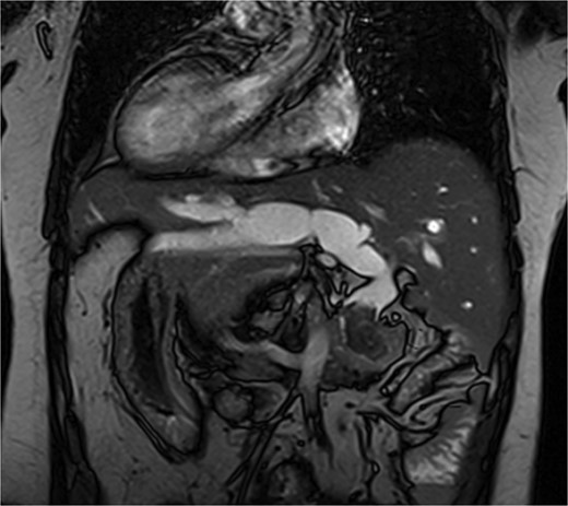 MRI shows a 26 mm stone in the distal common bile duct with bile duct dilation.