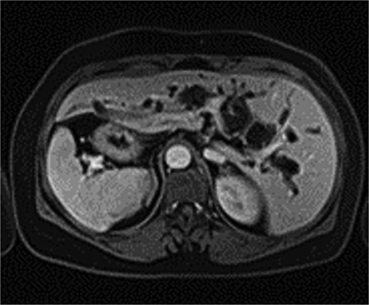 Abdominal organs in mirror-image arrangement.