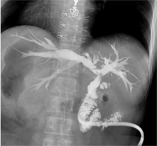 Postoperative cholangiography shows no residual stones in the bile duct.