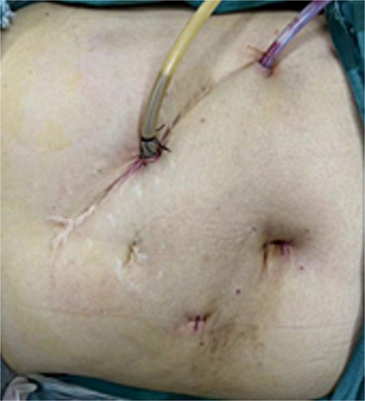 Postoperative condition of the patient’s abdominal incision.