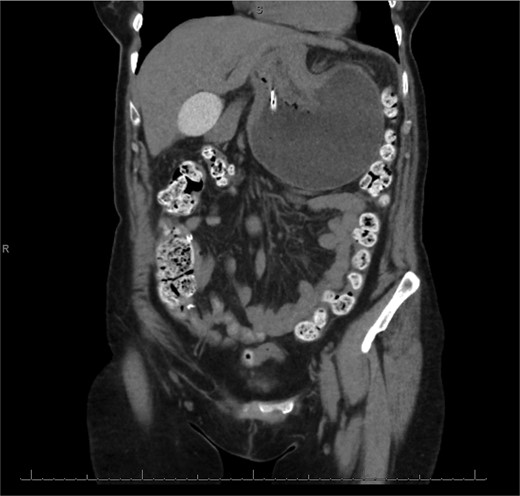 Coronal view of CT scan of abdomen and pelvis demonstrating gastric volvulus.