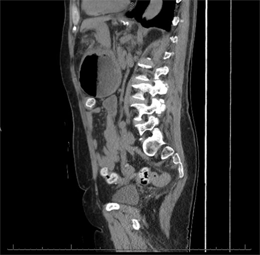 Sagittal view of CT scan of abdomen and pelvis demonstrating gastric volvulus.