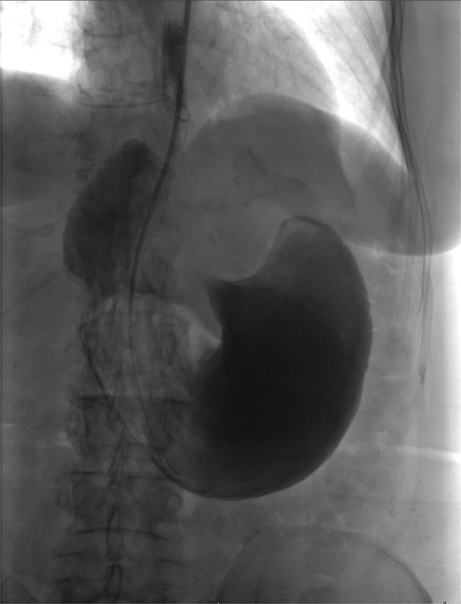 Upper GI study demonstrating no passage of contrast beyond stomach and 90° rotation.