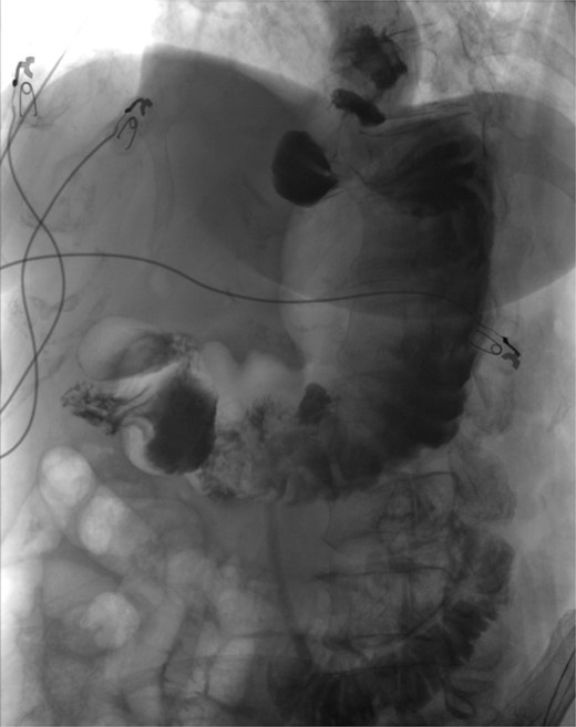 Upper GI study showing no leak after surgery.