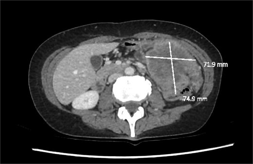 Axial slice of a CT demonstrating a large heterogenous mass in the left upper quadrant.