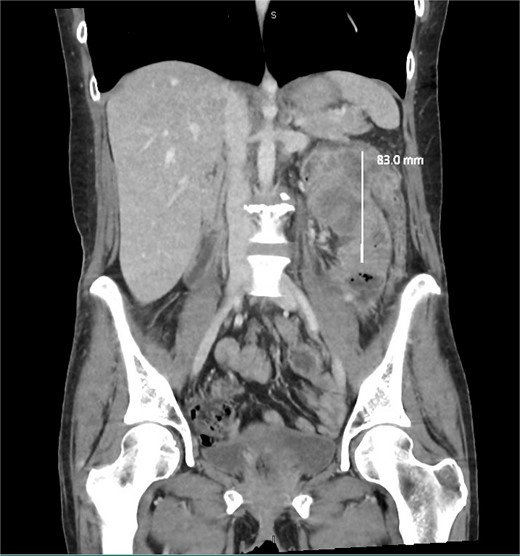 Coronal slice of a CT demonstrating necrotic mass arising from the large bowel with significant wall thickening.
