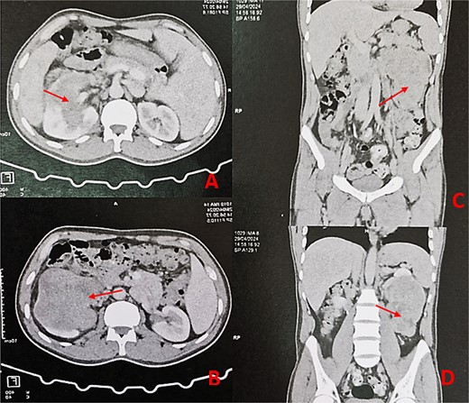 Thoraco-abdominopelvic CT scan with axial (A, B) and sagittal (C, D) images demonstrating a large heterogeneous mass (arrows) centered on the middle and lower thirds of the left kidney.