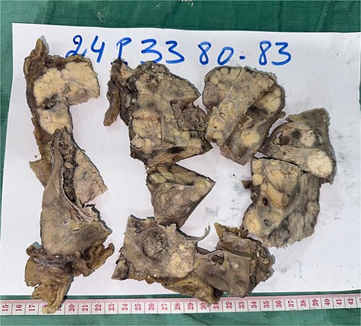 Radical nephrectomy reveals polylobulated white-yellow infiltrating tumor on gross examination.