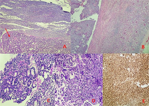 Microscopic findings: (A, B) hematoxylin–eosin (H&E) stain at low magnification reveals a mixed tumor with blastemal and epithelial components (arrow), showing well-defined borders pushing renal parenchyma. (C, D) Hematoxylin–eosin (H&E) stain at 40× magnification displays blastemal cells with scant cytoplasm, small size, mitotic activity, rounded overlapping nuclei, and primitive tubular structures. (E) Immunohistochemical analysis demonstrates diffuse nuclear staining for WT1.