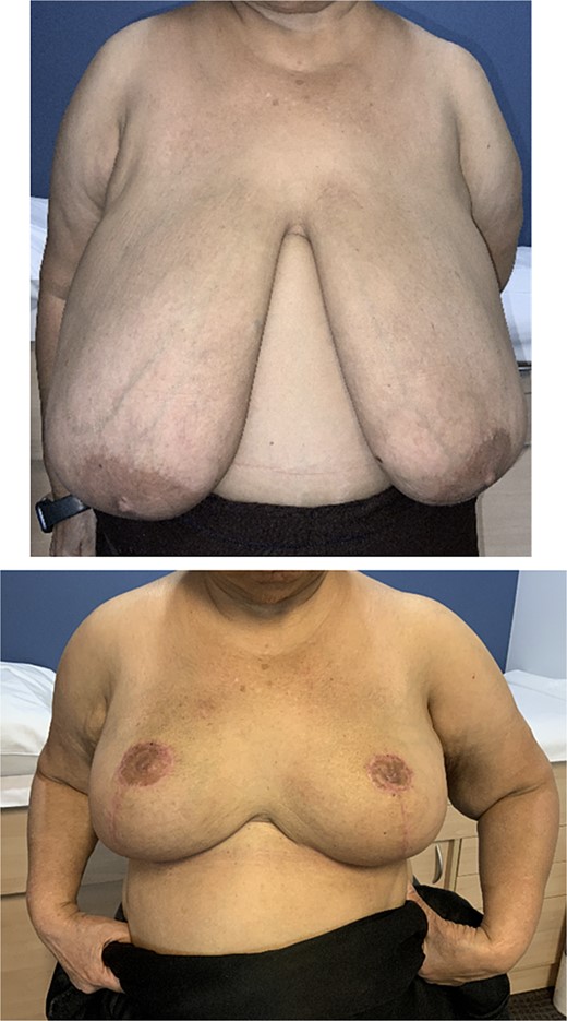 Photographs of patient PK preoperatively and at 6 months follow up.