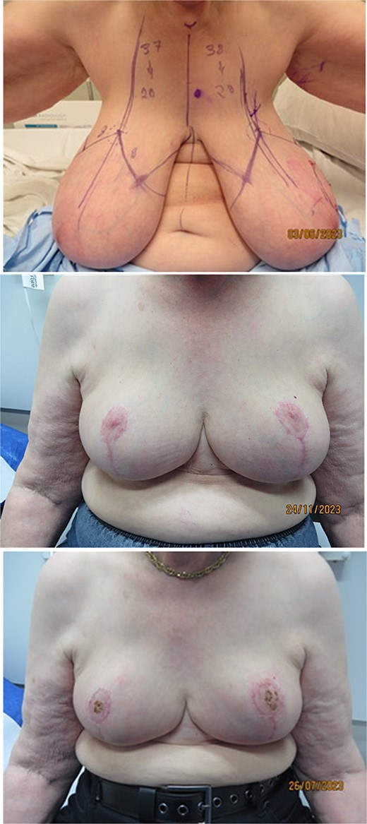 Patient CH with preoperative markup and postoperative result.