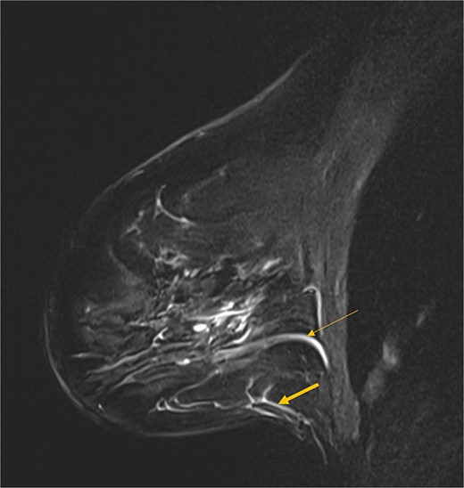 Sagittal MRI image showing the fourth AICAP vessels in the breast septum (thin arrow) and the fifth AICAP vessels travelling in the subcutaneous tissue (thick arrow).