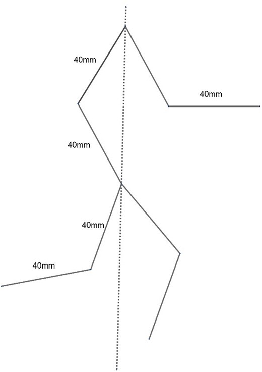 Position and dimensions of scar. Dotted line – midline; solid lines – scar.