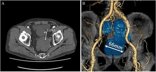 Preoperative computed tomography imaging showing a giant left internal iliac artery aneurysm in a dumpling-like cluster with a maximum short diameter of 66 mm. A—Axial image, B—3D image. LIIAA, left internal iliac artery aneurysm.