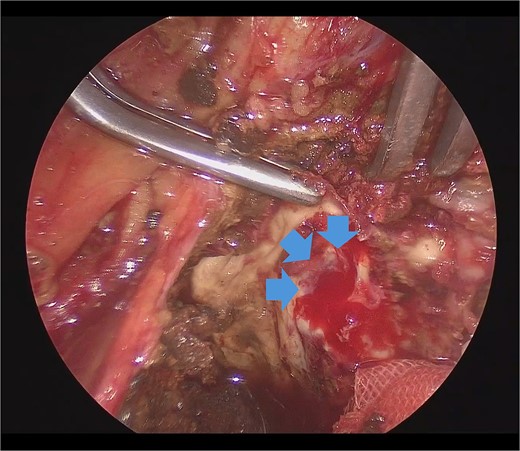 Laparoscopic view of the orifice of the feeding vessel (blue arrow).