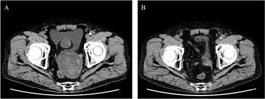 Postoperative computed tomography showing a reduction in aneurysm size. A—Preoperative image, B—10-month postoperative image.