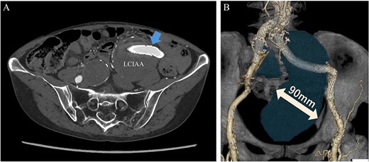 Preoperative computed tomography imaging showing a left common iliac artery aneurysm and internal iliac artery aneurysm with a maximum short diameter of 90 mm. A—Axial image, B—3D image. LCIAA, left common iliac artery aneurysm.