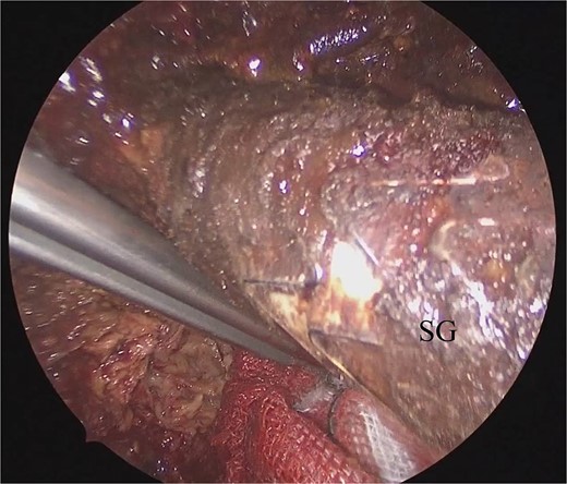 Laparoscopic view of checking for type I endoleak presence. SG, stent graft.