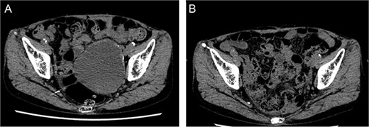Postoperative computed tomography showing a reduction in aneurysm size. A—Preoperative image, B—7-month postoperative image.