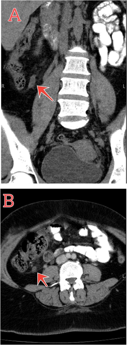 Abdomen–pelvic CT scan shows tip appendicitis. (A and B) Coronal and axial sections show the distal part of a blind-ended tubular structure measuring about 8 mm arising from the cecum (red arrows), associated with mucosal enhancement and mild surrounding fat stranding.
