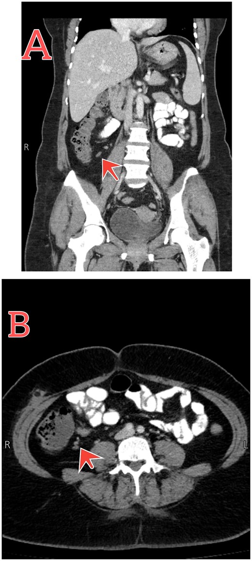Follow-up abdomen–pelvic CT scan. (A and B) Coronal and axial sections show resolution of the inflammatory process postconservative management (red arrows).