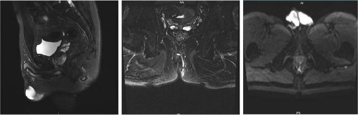 Preoperative perianal magnetic resonance imaging (MRI) examination.