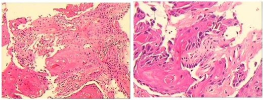 Postoperative pathology indicated squamous cell carcinoma.