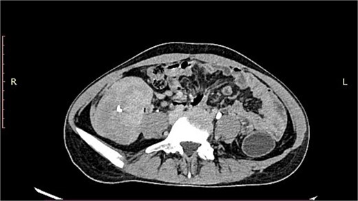 CT image showing a well-defined smooth lobulated heterogeneously enhancing mass lesion in the right paracolic gutter and right iliac fossa, with calcific focus within.