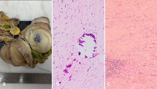 (a) Well-circumscribed mass arising from the wall of the ileum. (b) Calcifications inside the fibrous tumour. (c) Lymphoid aggregates in the bland spindle cell tumor.